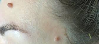 Riscul de cancer este mai mare la persoanele care au mai mult de 40 de aluniţe. IndepÄƒrtarea ChirurgicalÄƒ A AluniÈ›elor Excizie Nevi Dr Dan LazÄƒr