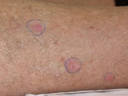 When this happens, it can be difficult to treat, and the outlook may be poor. Rashes Affecting The Lower Legs Dermnet Nz