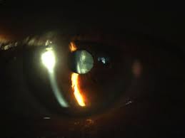 Otherwise he had been in good health. Cataracta Corticalis Praxis Zeitz Franko Zeitz