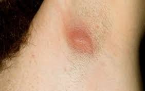 Itchiness is one possible sign of skin cancer, so if you&#x27;re constantly itchy in one spot and there&#x27;s no. Pin On Armpit Cysts