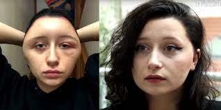There are numerous chemicals in hair color, but the one that is most commonly associated with allergies is paraphenylenediamine (a.k.a. French Student S Head Swelled From Allergic Reaction To Ppd Hair Dye