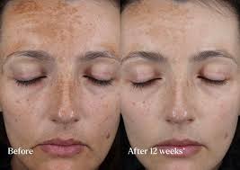 OK, I'm so gobsmacked by this B&A image for Caroline Hirons new Skin Rocks  Hyperpigmentation Serum, I had to post it before I even tested the product. 