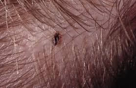 Image result for pubic lice symptoms