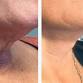 PLATELET RICH FIBRIN AND RADIESSE NECK TREATMENT event image