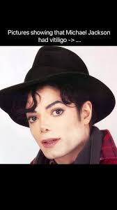 Michael Jackson Autopsy: Facts and Skin Condition Revealed