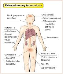 Image result for Extrapulmonary Tuberculosis