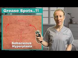 Image result for Sebaceous Hyperplasia