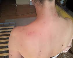 V oblasti se daří vzácným rostlinám i. Stenice Parazitujici Na Lidske Krvi Se Nevyskytuji Jen Tam Kde Je Spina Novinky Cz