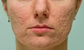 Menghilangkan bopeng dg treatment subsisi.for sharing tinggalkan komentar di bawah ya. Pilihan Terapi Untuk Atrophic Acne Scar Alomedika