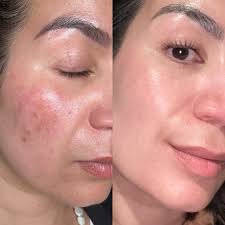 Werkt een rood LED Light masker echt? ⋆ Beautylab.nl