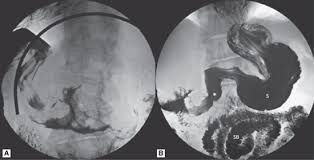 Image result for Succussion Splash