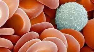 Uno dei campanelli d'allarme che può suggerire una leucemia fulminante è un'emorragia cutanea, caratterizzata dalla comparsa di macchie sulla pelle o. Leucemia Fulminante Che Cos E I Sintomi La Cura Unica Radio