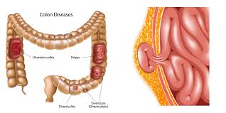 Image result for Diverticulitis