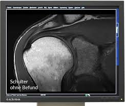 Also ich will keine diagnose, nur wissen ob das mrt bild so aussieht wie andere auch und was die weißen stellen bedeuten. Mrt Der Schulter Hochwertige Untersuchung In Der Alta Klinik