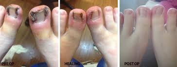 Image of Toenail removal healing stages pictures