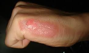 This type of burn involves the second layer of skin being affected and results in some blistering of the skin. Burn Wikipedia