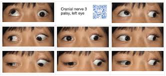 Image result for Pupillary Paralysis