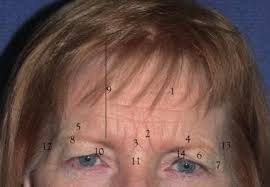 Image result for Forehead Regional Block