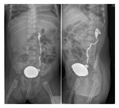 Image result for Voiding Cystourethrogram