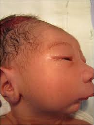 Pierre-Robinův syndrom, sekvence