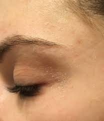 Misc Recommendations For Dry Flaky Skin Around Eyes Dry Skin Around Eyes Dry Flaky Skin Flaky Skin On Face