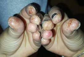 No es fácil ser el poseedor del récord de las uñas de los pies más largas del mundo. La Epidemia Oculta Tras Las Unas Permanentes La Solucion Seria Prohibirlas Historias