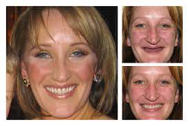 Maybe you would like to learn more about one of these? Cosmetic Dentures Smile Design By Ash