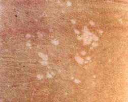 Complementary medicine is used along with standard medical treatment but is not considered by itself to be standard treatment. Tinea Versicolor Symptoms Causes And Treatment