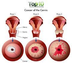 If you have any of these signs, see your doctor. Fight Against Cervical Cancer All About Aloe Vera