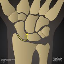 Image result for Scapholunate Dislocation