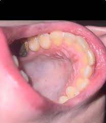 Image result for Canker sores roof of mouth