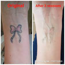 Inner Wrist Tattoo Inner Wrist Tattoos Cover Tattoo Laser Tattoo