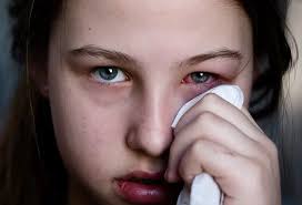 Image result for Allergic Conjunctivitis