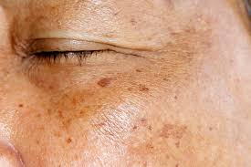 Instead of a few specific spots, this involves larger areas of pigmentation that make your skin look darker in some areas, lighter in others. How To Treat Hyperpigmentation Dark Spots Uneven Skin Tone A Beauty Edit