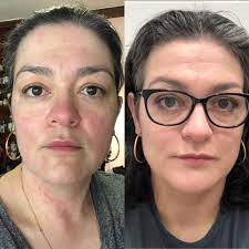 B A 3 Months After I Discovered My Weirdo Allergy To Castor Oil And Eliminated It Completely From My Routine After Years Of Being Told I Had Rosacea Thank God For Paula S Choice