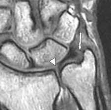 The tfcc is part of an extensive group of ligaments that help stabilize both the small wrist bones and the ulna bone. Triangular Fibrocartilage Tear Radsource