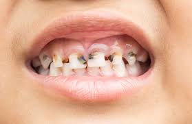 A cavity presents itself with a brown, black or gray spot on your tooth. Tooth Decay In Kids Signs Of Cavities And Treatment Options Absolute Dental