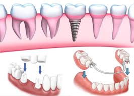 Trồng răng giả loại nào tốt nhất hiện nay? - Nha Khoa Thúy Đức