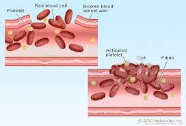 Blood Clot Picture Image On Medicinenet Com