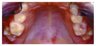 Image result for ochrana chrupu