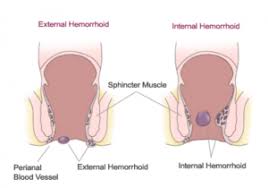 Internal hemorrhoids are a disease caused by impaired blood circulation in the hemorrhoid vein in the lower rectum. Hemorrhoids Bonheur Md Gastroenterologist