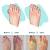Celebrities With Bunions