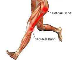 Le réseau itbs est également présent en france, au canada et à new york. Iliotibial Band Syndrome Itbs Halo Clinic