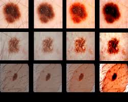 It is more common in older people, and more men than women tend to develop it. Example Images Of The Skin Cancer Regions Before And After Image Download Scientific Diagram