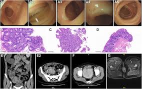 Image result for Blood in stool