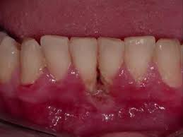 Stage 3 of periodontal disease in dogs. Gums Bleed Stop Bleeding Gum Cure Swollen Red Bleedings Youtube