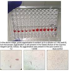 Image result for Coombs