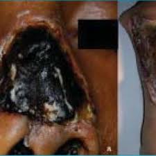 La mucormicosis es una infección oportunista esporádica pero cosmopolita que ocurre en pacientes con enfermedades serias subyacentes, como acidosis diabética o leucemia aguda, y en pacientes. Pdf Mucormicosis Cutanea Primaria A Proposito De Dos Casos Revision De La Literatura