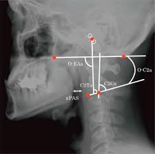 Create your own flashcards or choose from millions created by other students. Occipital And External Acoustic Meatus To Axis Angle As A Predictor Of The Oropharyngeal Space In Healthy Volunteers A Novel Parameter For Craniocervical Junction Alignment The Spine Journal