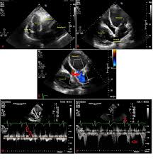 A heart transplant may be considered if: Heterotopic Heart Transplant What Pictures Are We Expecting American College Of Cardiology